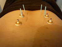 はりきゅう併用治療